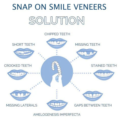 Instant Smile Clip-On Veneers Kit